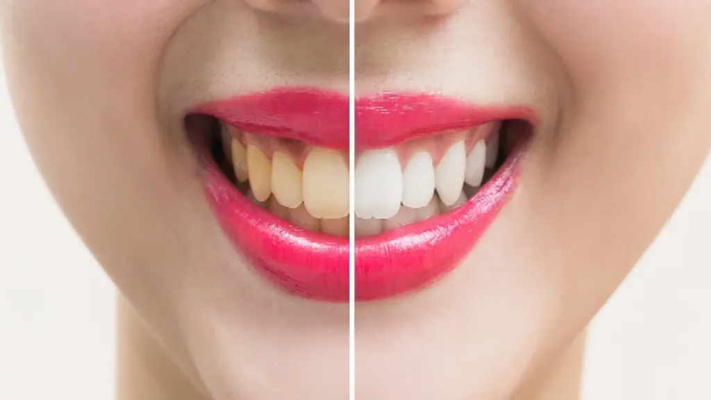 Antes e depois de clareamento dental