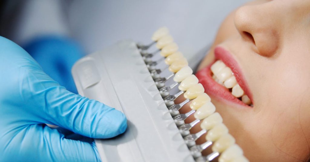 Conferindo qual a faceta dentária mais adequada para paciente