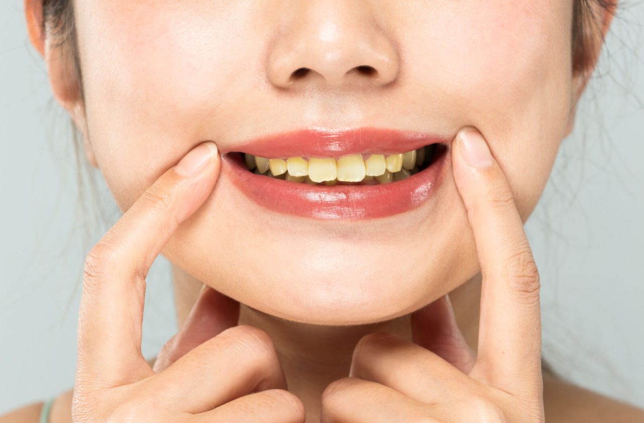 Mulher puxando seu sorriso, mostrando os dentes amarelados
