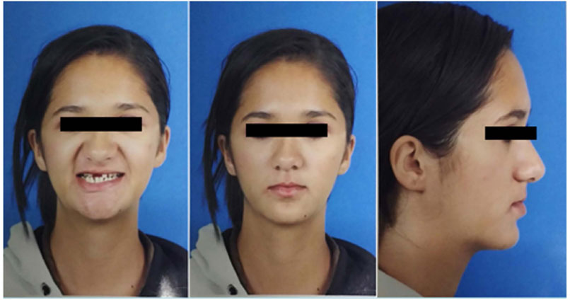 Fotos de vários ângulos de mulher com Síndrome de Rieger, as imagens tampam o olho dela, para manter o anonimato.