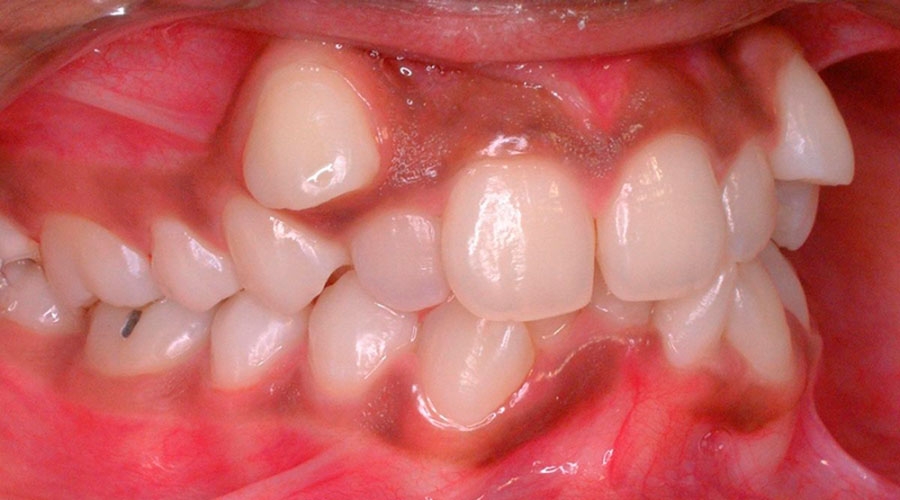 boca com apinhamento dental e dentes a mais