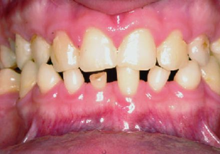 foto de dente com aplasia dentária