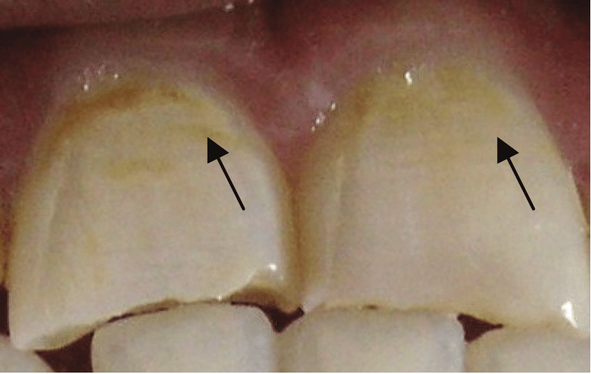 dente com desmineralização na parte de cima e setas apontando pra essa parte