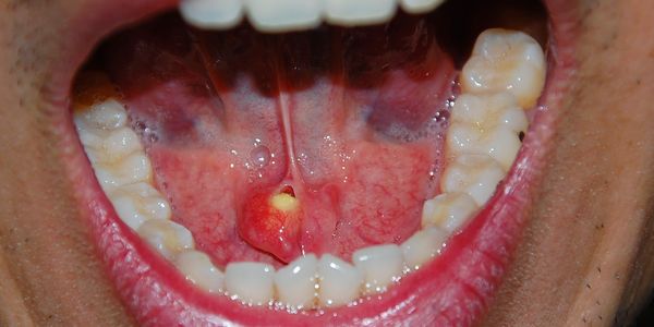 pessoa de boca aberta mostrando inflamação de glândula salivar embaixo da língua