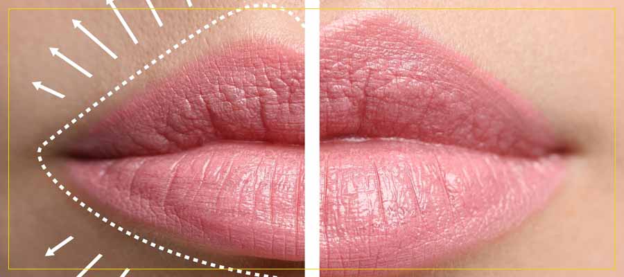 Imagem cortada ao meio. Do lado esquerdo tem um lábio fino e em volta o desenho dele maior com setas para cima. Do lado direito seria o resultado depois da cirurgia de lip lift.