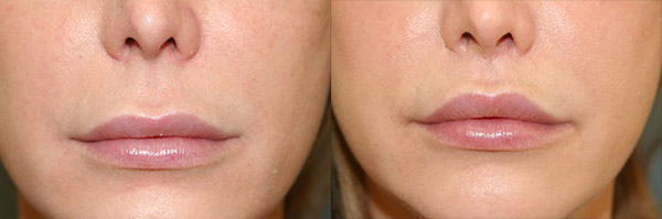 antes e depois da cirurgia de lip lifting