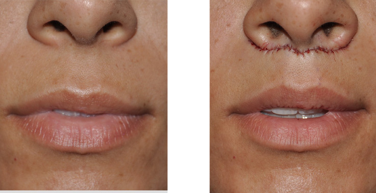 antes e depois de lip lift Bullhorn Subnasal