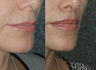 antes e depois de Lip Lift Italiano