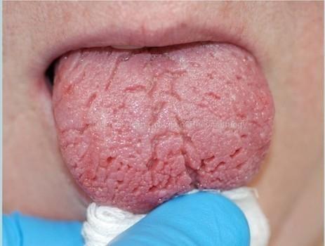 língua com várias rachaduras abertas, pois paciente tem síndrome de Sjögren