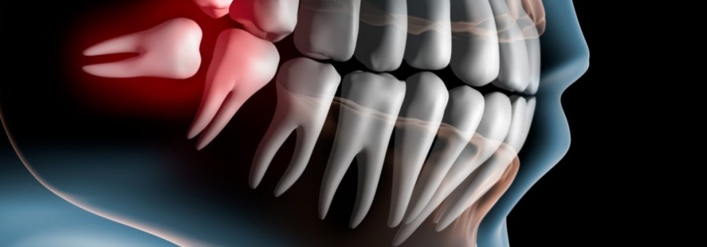 Imagem criada artificialmente mostrando a arcada dentária e um dente siso deitado com luz vermelha em sua volta.