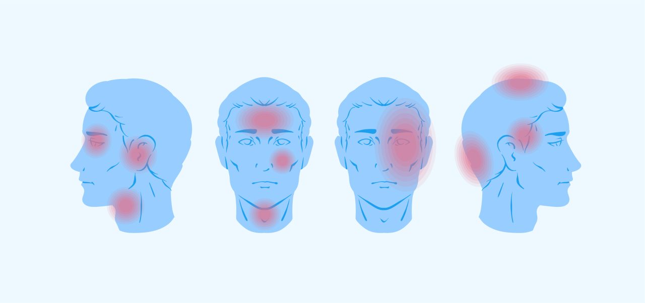 Desenho mostra com pontos vermelhos regiões da cabeça que a enxaqueca faz doer.