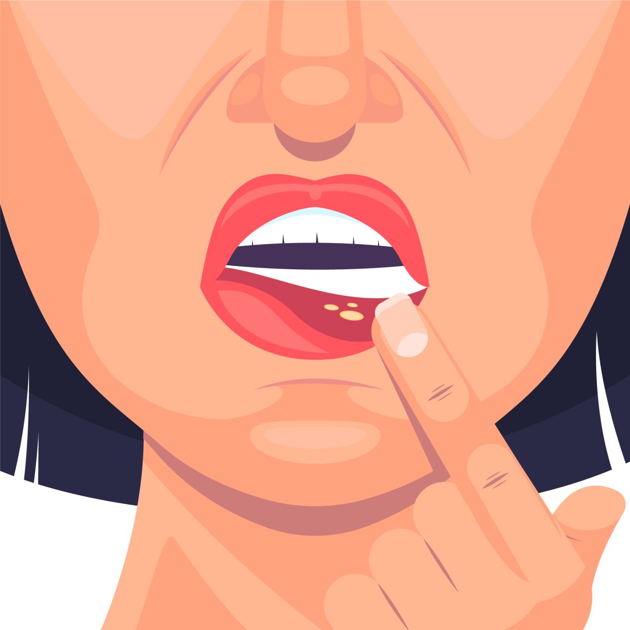 Desenho de mulher apontando para o herpes em sua gengiva.