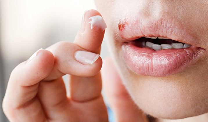 Mulher aplicando pomada em herpes labial