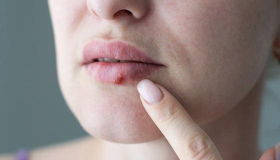 Mulher apontando para o herpes em seu lábio inferior.