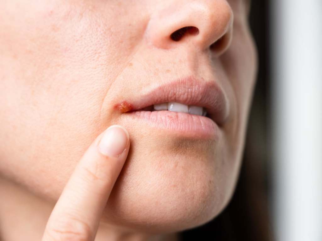 Mulher apontando para o herpes no canto do seu lábio.