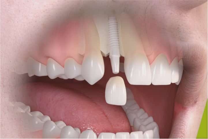 Dente de porcelana sendo implantando em parafuso de zircônia - Quais os melhores materiais usados nos implantes dentários?