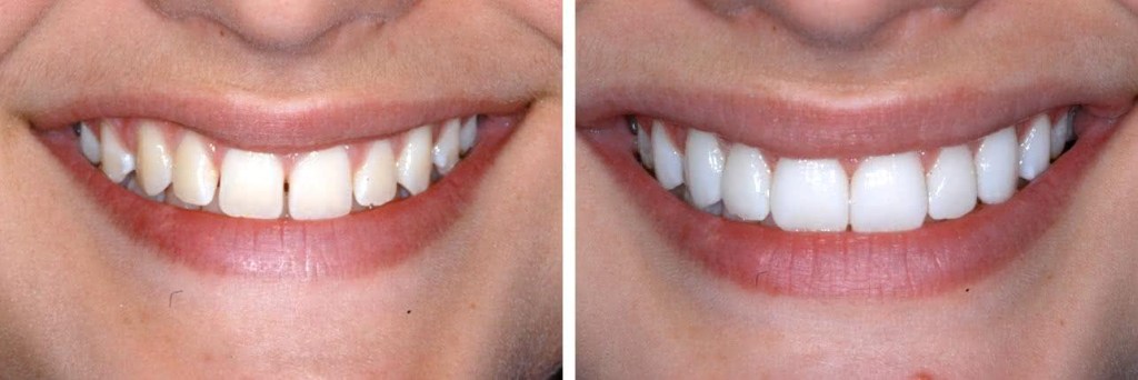 antes e depois de implantes dentários de porcelana