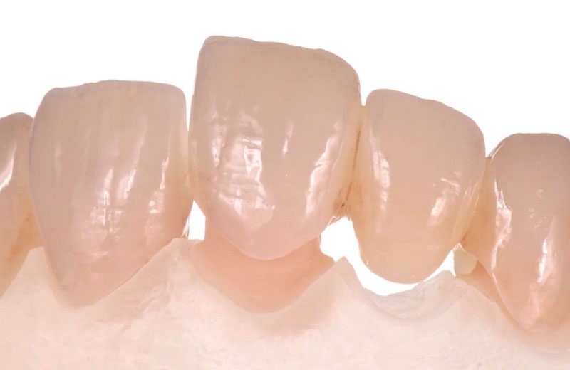 lentes de contato dentais Silicato de lítio reforçado por zircônia