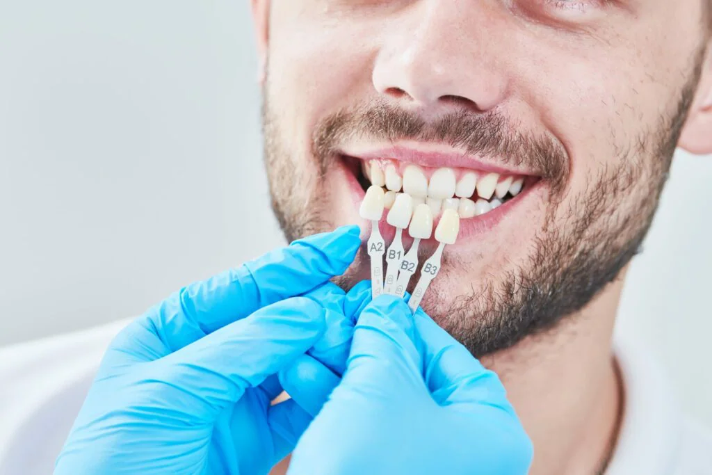 Dentista usa luva azul e está testando qual lente de contato dental combina mais com a cor de dente do paciente