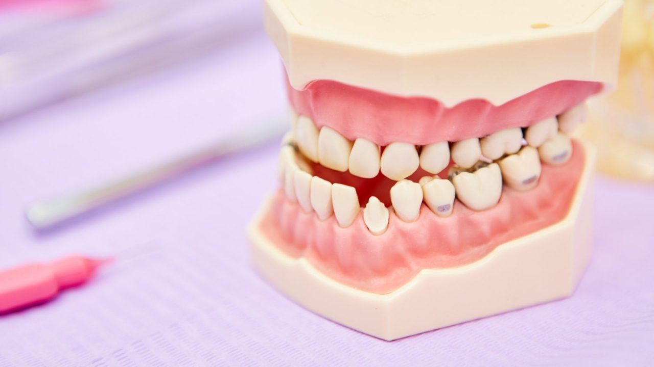 Molde boca e dentes com uma má oclusão dentária