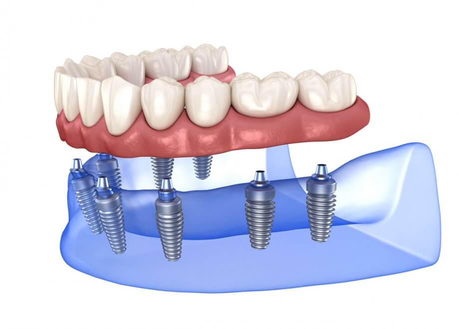 Desenho 3d de implantando os dentes nos parafusos de titânio.