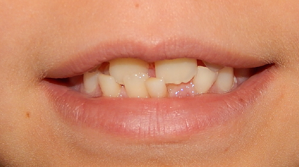 imagem focando em boca de criança que tem mordida cruzada anterior