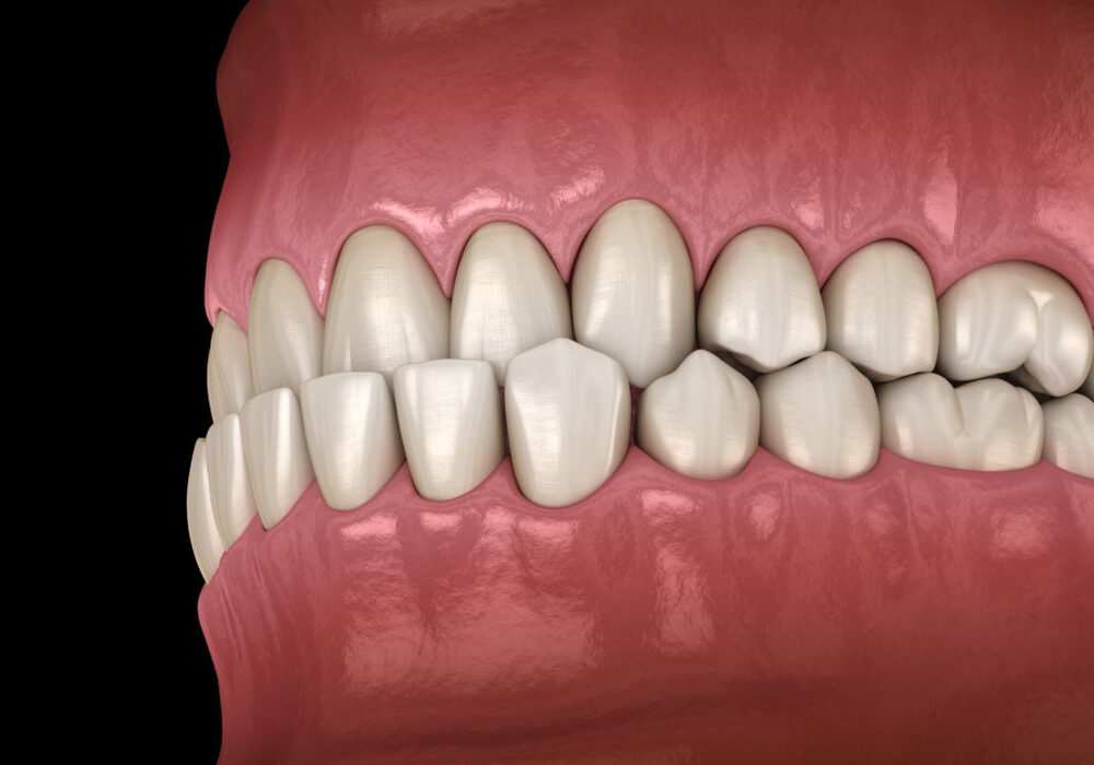 Imagem digital de mordida cruzada anterior