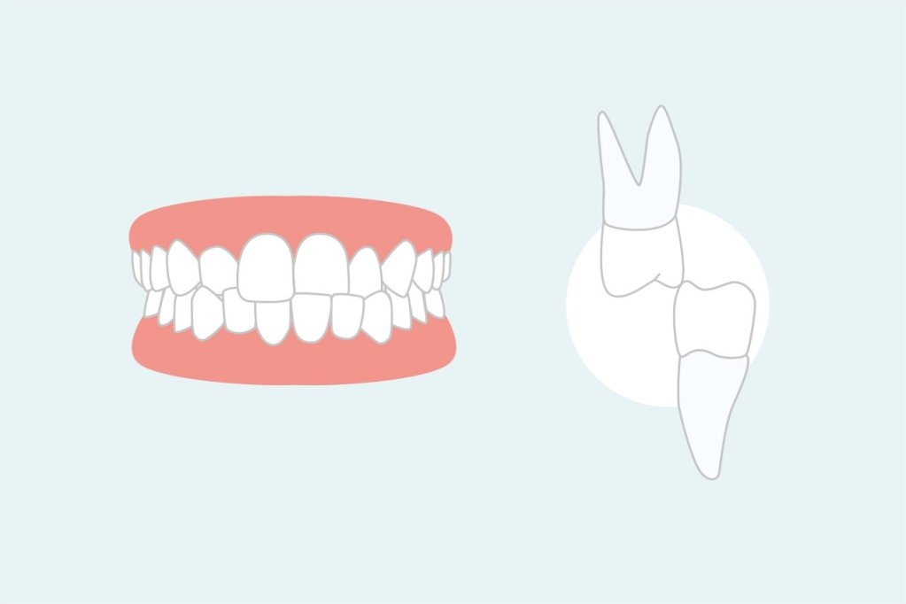 desenho de boca com mordida cruzada e ao lado dois dentes cruzados