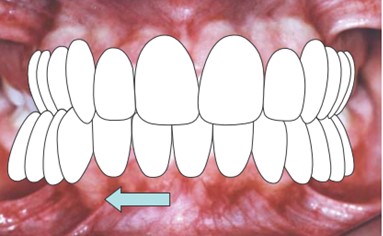 desenho de mordida cruzada posterior