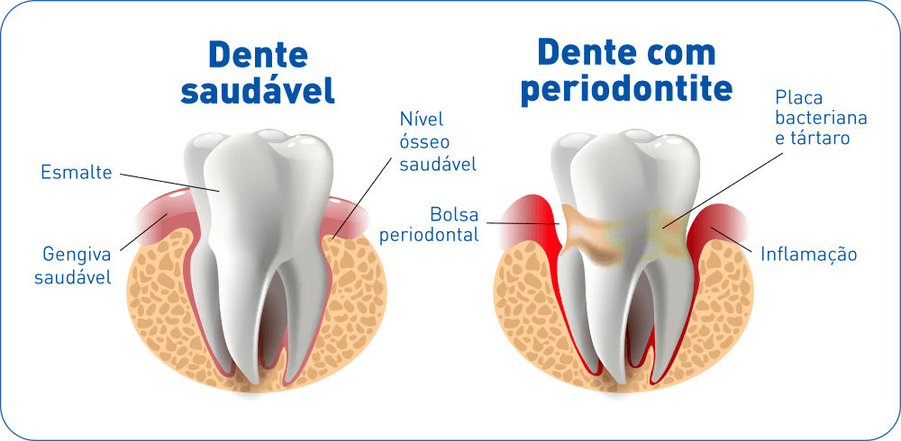 desenho comparando um dente saudável e um dente com periodontite