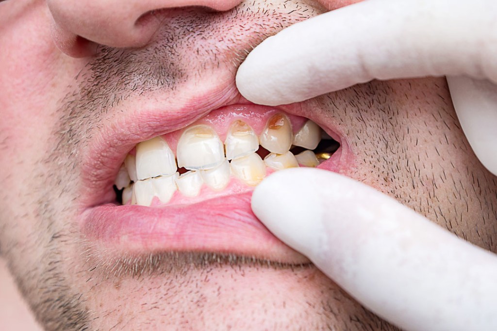 Dentista usando luva branca está afastando os lábios do paciente para ver seus dentes, que possui hipoplasia