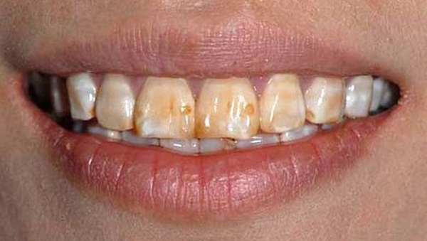 Boca de pessoa com hipoplasia de esmalte dentário, tendo manchas amarelas.