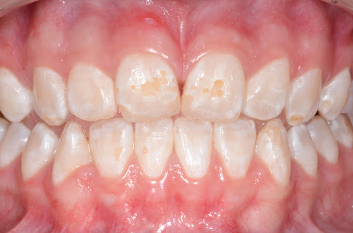 Boca de pessoa com hipoplasia de esmalte dentário, tendo manchas brancas.
