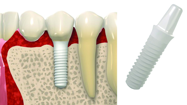 Implante de cerâmica