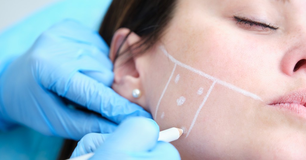 Dentista está fazendo marcação com lápis branco em rosto de paciente para poder aplicar botox.