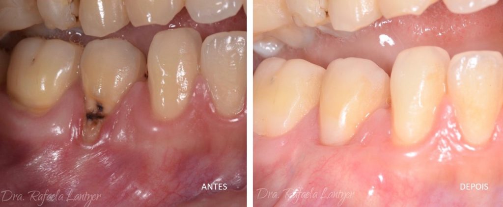 antes e depois de recobrimento radicular