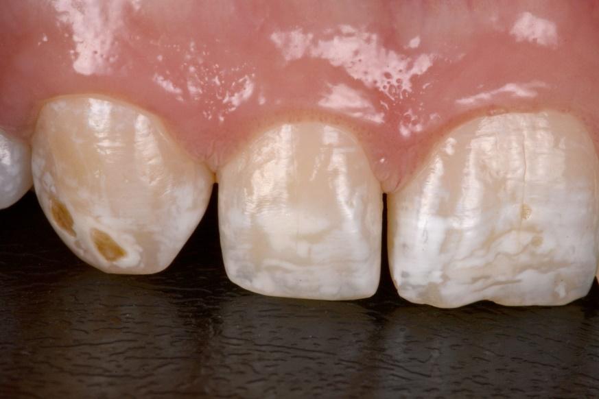 Dente com esmalte desmineralizado