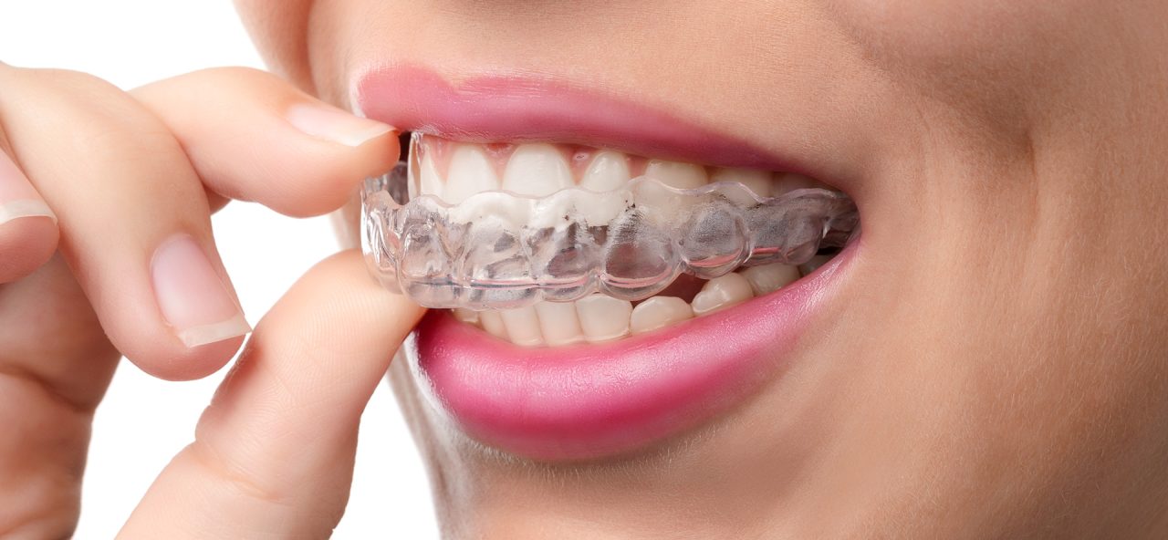 Mulher colocando no dente sua placa interoclusal