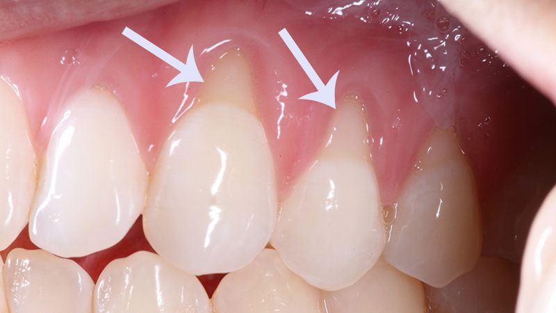Imagem de boca com retração gengiva, mostrando as raízes expostas.