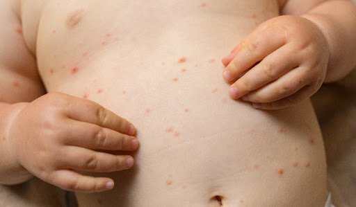 Criança com sarampo, tem várias manchinhas vermelhas na barriga.