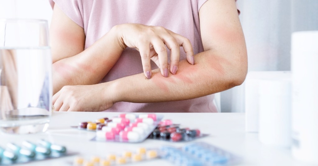 Mulher com alergia no braço, está coçando; Na mesa tem vários medicamentos e um copo de água.