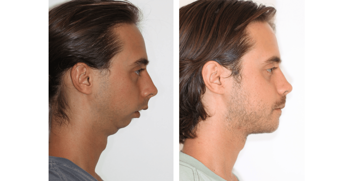 Antes e depois da mandíbula de homem que fez cirurgia ortognática