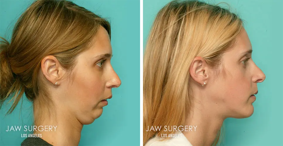 Antes e depois da mandíbula de mulher que fez cirurgia ortognática