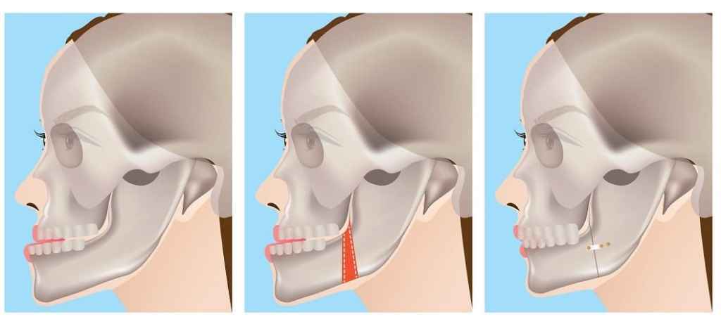 Desenho mostrando antes, durante e depois da cirurgia ortognática