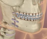 Cirurgia Ortogn tica Suas D vidas Respondidas