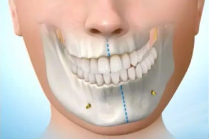 Desenho mostrando assimetria facial