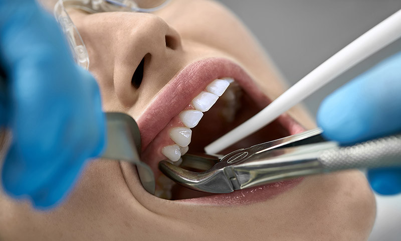 Dentista extraindo dente de paciente. A imagem está bem próxima da boca.