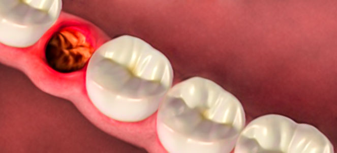 Imagem mostrando inflamação após extração de dente, na gengiva.