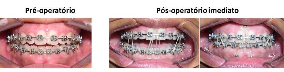 Pré e pós-operatório da ortognática como fica o aparelho ortodôntico.