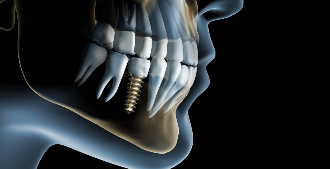 imagem mostra como fica um implante ao lado de outros dentes, a imagem é criada digitalmente